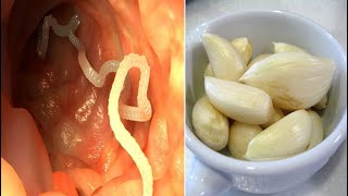 How to Get Rid of Your Intestinal Worms Fast - Natural Remedy To Remove Intestinal Parasites!
