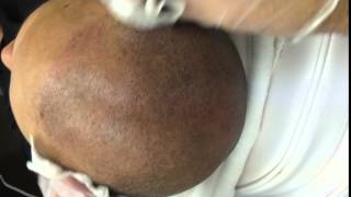 Results of having a Scalp Micropigmentation treatment by Tino Barbone at SMC