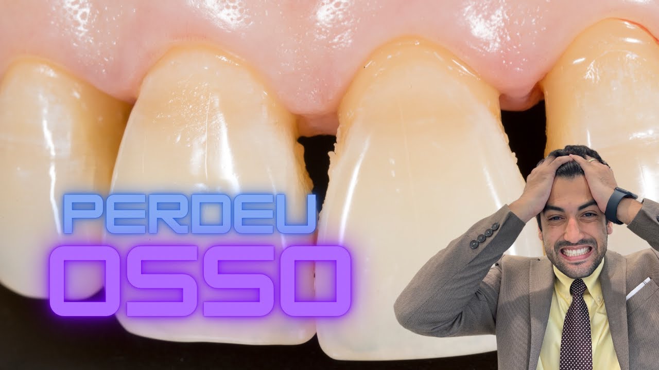 PERDA ÓSSEA NA BOCA E AO REDOR DOS DENTES!
