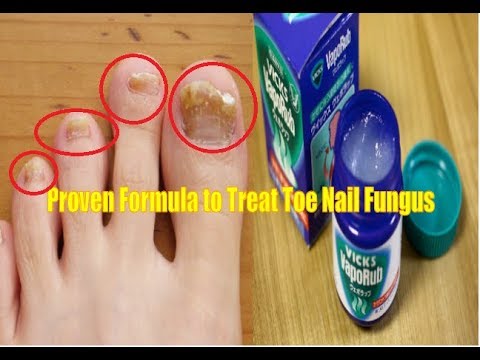 Kuko halamang-singaw sa aking mga paa sa pagitan ng mga daliri sa paa Ointments para sa paggamot ng interdigital halamang-singaw sa kanyang mga paa