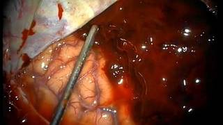 Hyper-Acute Subdural Hematoma- HD