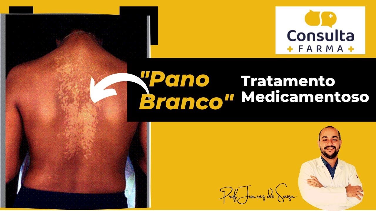 Micose: "Pano Branco" | Tratamento medicamentoso