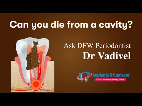Can you die from a cavity? Ask Board certified Surgeon Dr Vadivel, Implants&Gumcare, DallasFortworth
