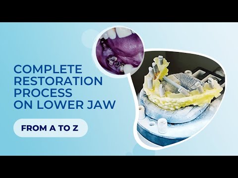 Complete restoration process on lower jaw FROM A to Z. MULTI UNIT TECHNOLOGY & digital impression