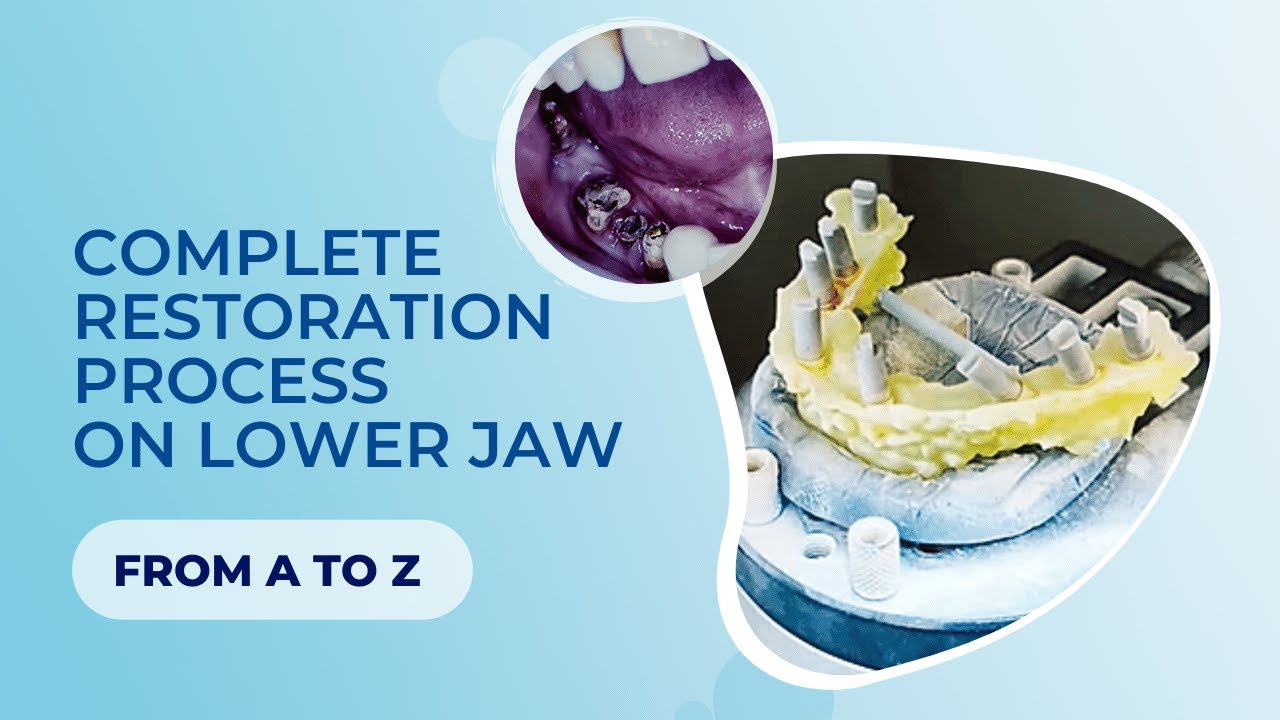Complete restoration process on lower jaw FROM A to Z. MULTI UNIT TECHNOLOGY & digital impression