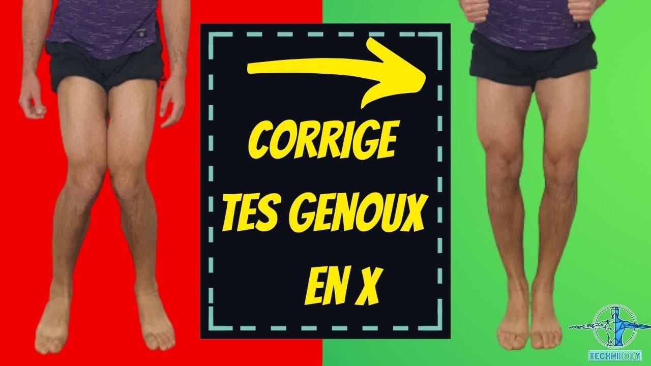 genou en x ou valgus - exercice kiné pour le corriger