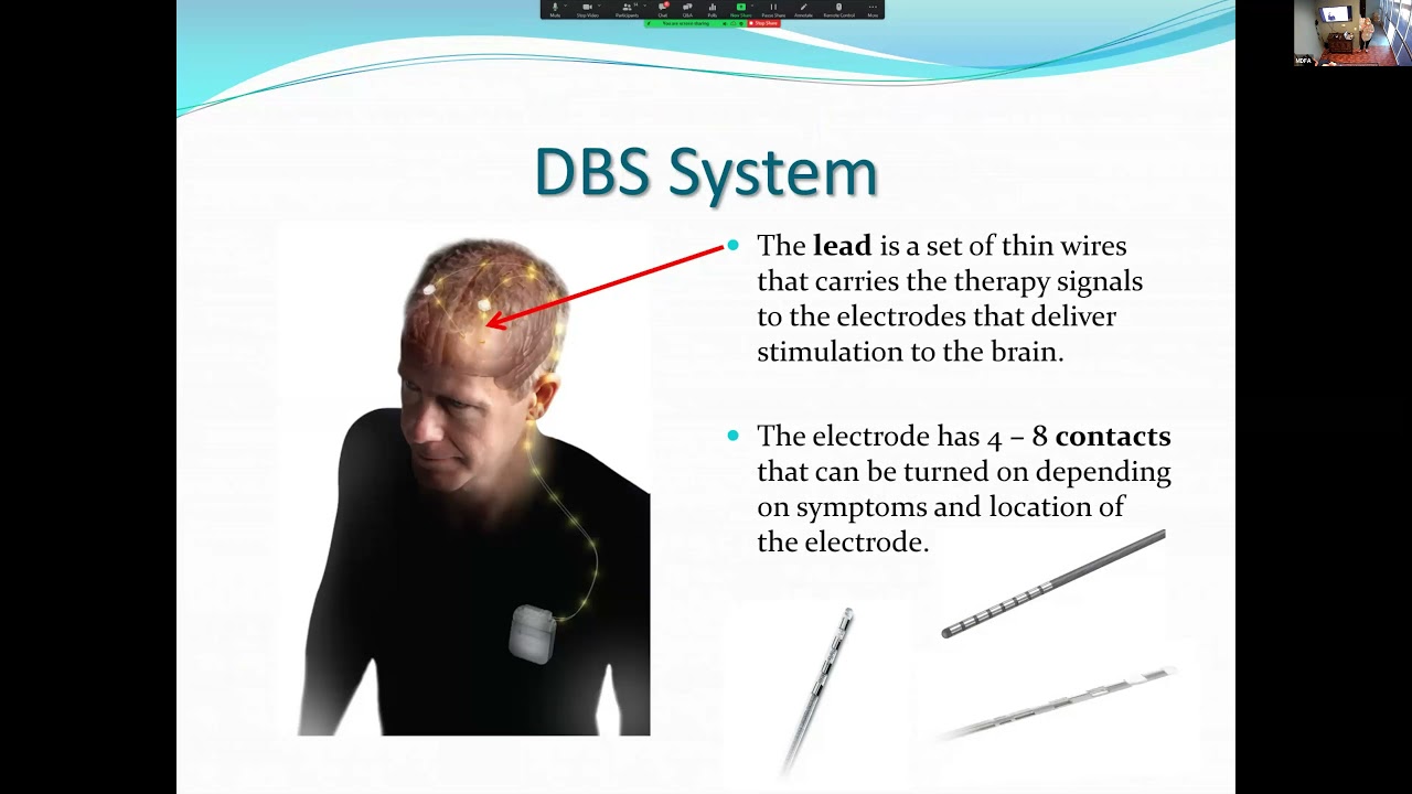 Learn about Deep Brain Stimulation (DBS)
