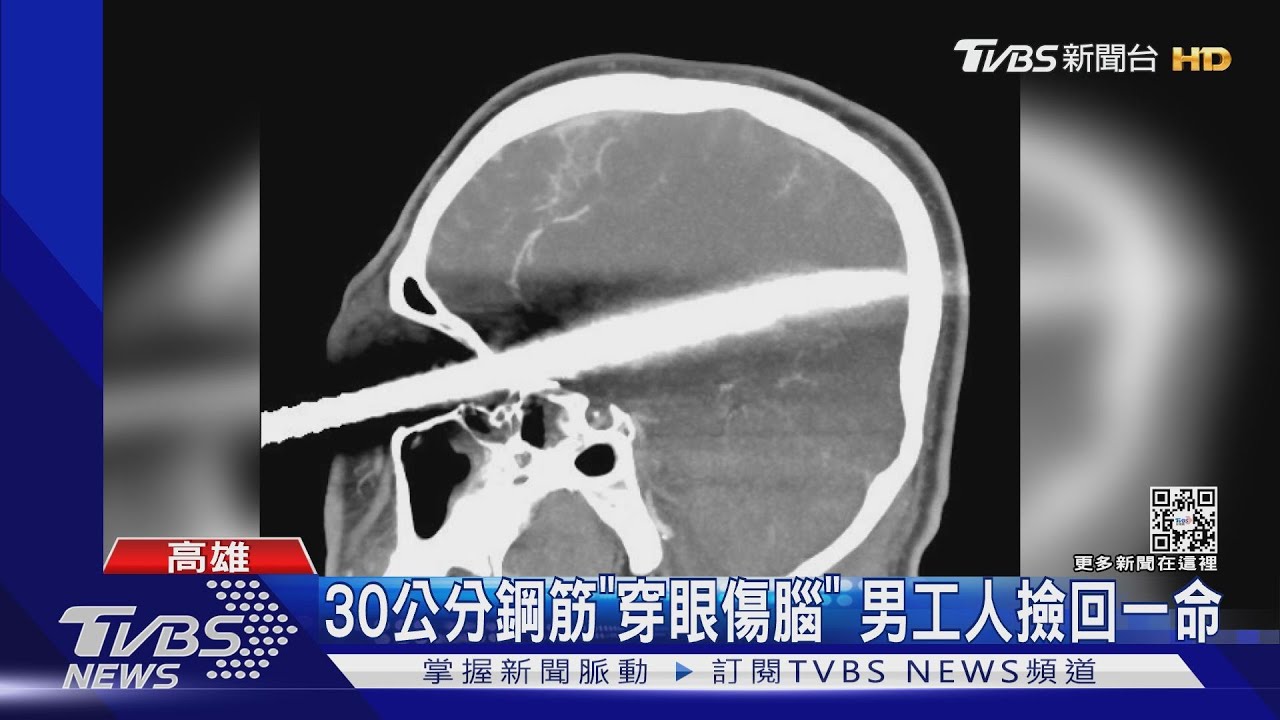 30公分鋼筋「穿眼」 男工人撿回一命認出妻兒「感動」