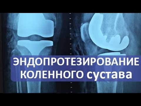 Отзывы о дексаметазоне при лечении суставов Лечение растяжения голеностопного сустава народными средствами
