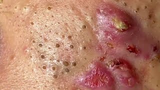 Removendo cravos e espinhas do rosto - Vídeo Muito Satisfatório