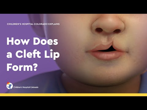 How Does a Cleft Lip Form?