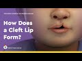 How Does A Cleft Lip Form