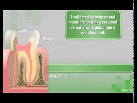 GuttaFlow2 D- Root Canal Filling System