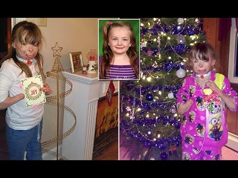 Click to Watch the Severely burned 5-year-old has only one Christmas wish this year ... and it will make you cry! video