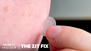 Microneedle Patch Stops Early Unpoppable Zits In Their Tracks | The Zit Fix | Beauty Insider