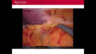 Core Videos (2024): Robotic-Assisted Laparoscopic Ureterocalicostomy and Pyelolithotomy