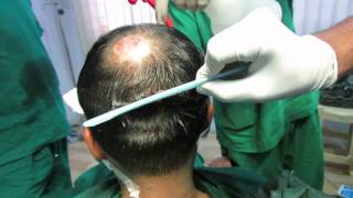 preview picture of video 'Crown Hair Transplant in India'