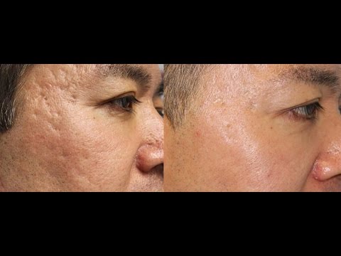 Amazing Laser Acne Scar Removal Results!