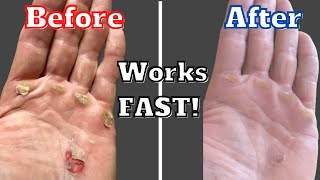 How to Treat Hand Calluses and Blisters - Gets Rid Fast!