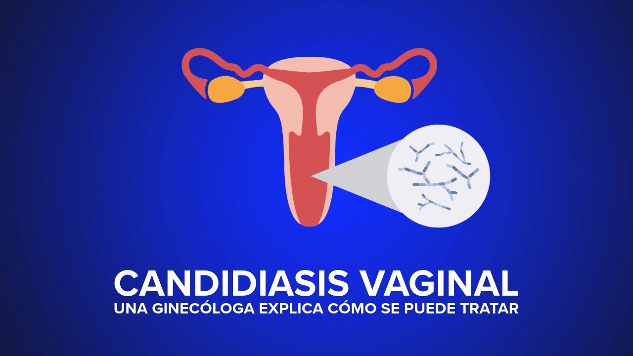 Thumbnail preview of Candidiasis Vaginal - Una ginecóloga explica cómo se puede tratar