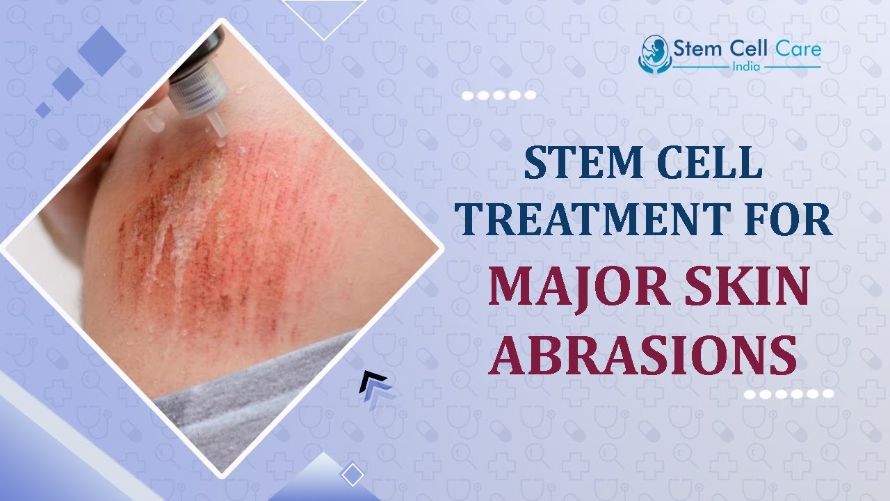 Major Skin Abrasions | Stem Cell Therapy For Major Skin Abrasions |Treatment For Major Skin Abrasion