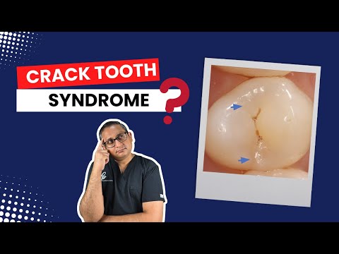 Crack Tooth Syndrome: Diagnosis & Treatment