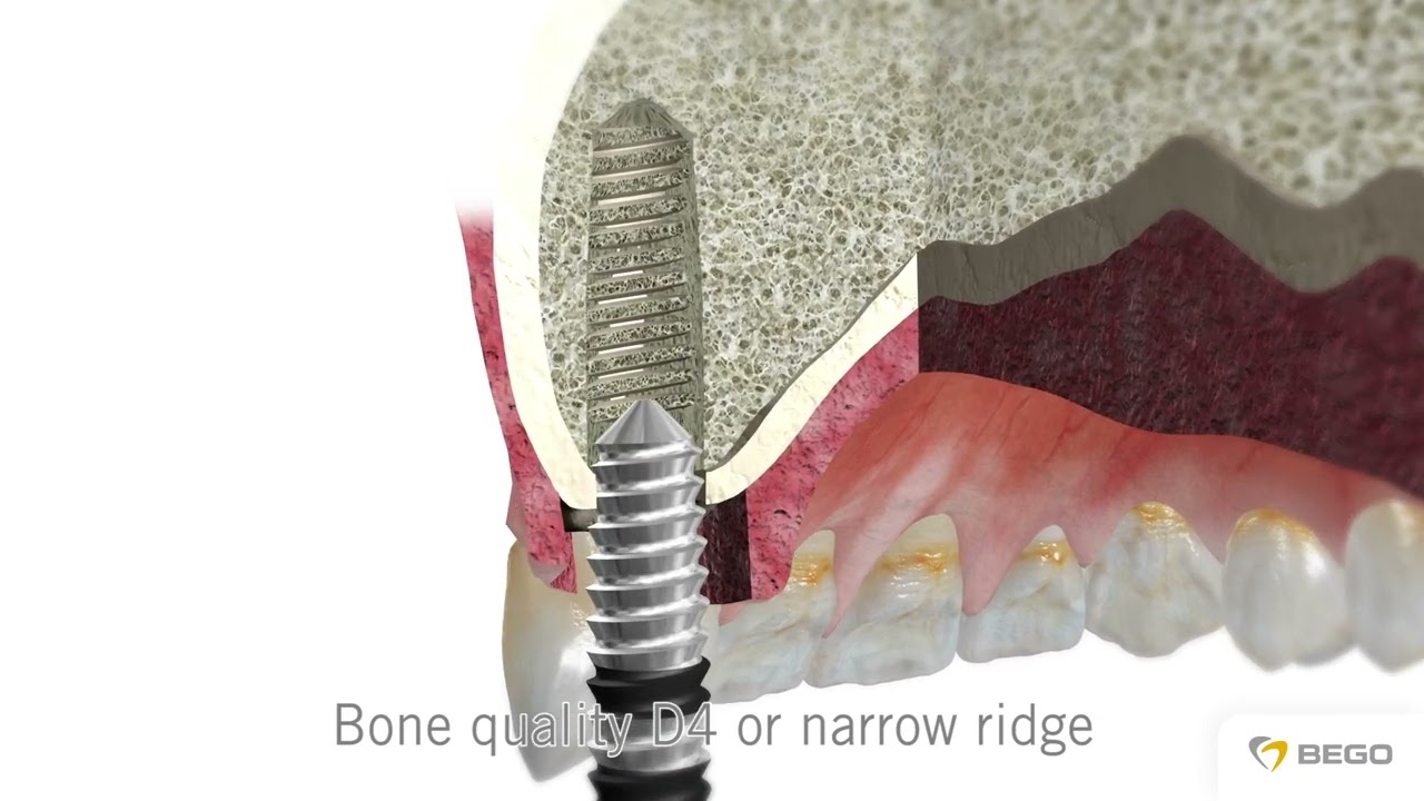 BEGO Semados® RI – procedura chirurgiczna