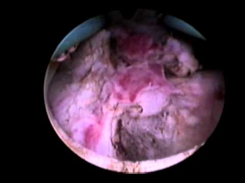 Reduktion von Prostatakrebs Alisheh. Behandlung von Prostatitis