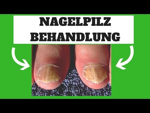 Dass man von gribka auf den Nägeln der Beine trinken muss Als plesnewyj gribok auf den Nägeln der Hände zu behandeln