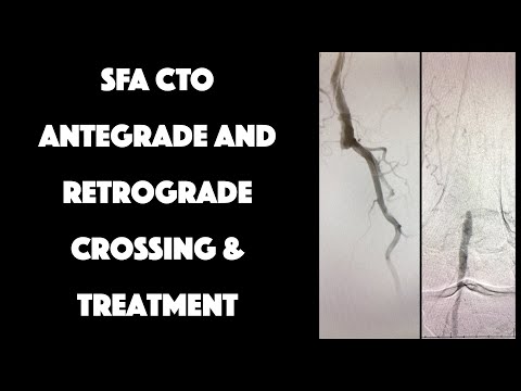 SFA CTO Antegrade and Retrograde Access for Crossing & Treatment