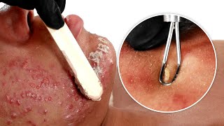 How To Treat Severe Acne | EXTREME Facial With Pimples And Blackheads Extraction