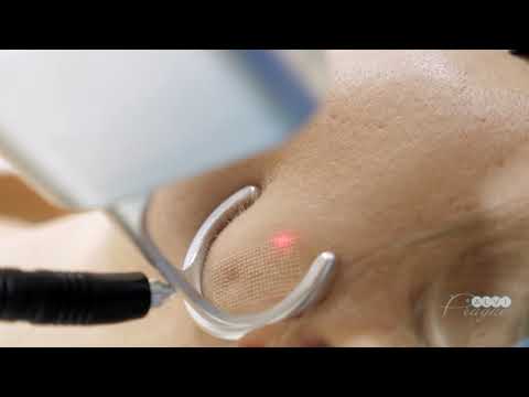 Фракционный лазер MED-X Laser CO2 с RF-модулем - видео