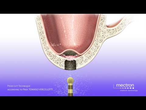 PIEZOSURGERY - Prof. Tomaso Vercellotti - Sinus lift with crestal approach - Piezo-Lift technique