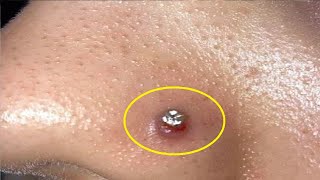 how to get rid of piercing bumps on nose super fast