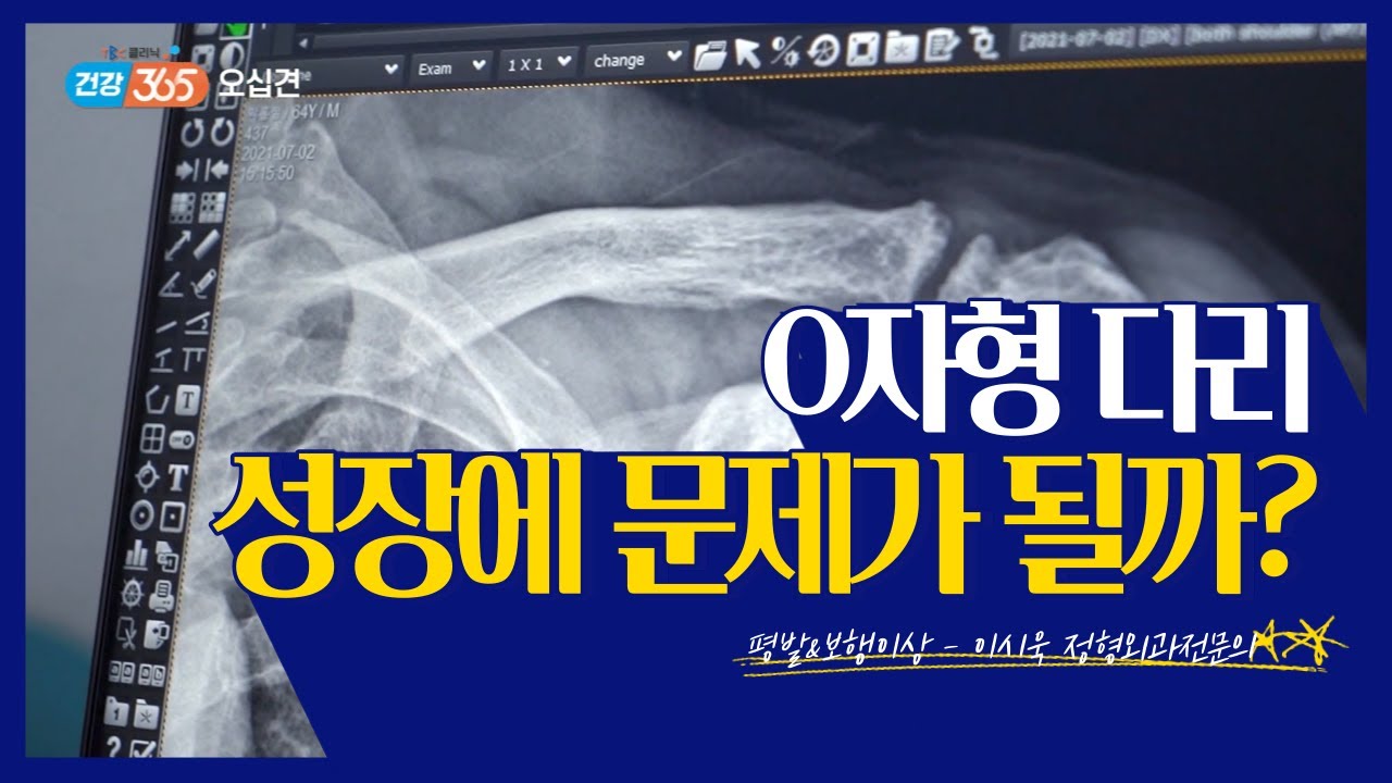 평발&보행이상 | 정형외과 이시욱 교수 관련사진