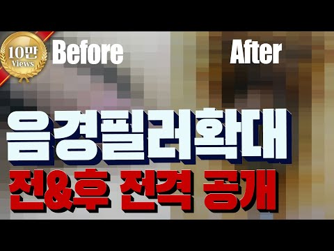 3D 영상으로 보는 필러음경확대의 수술전후 변화 - YouTube