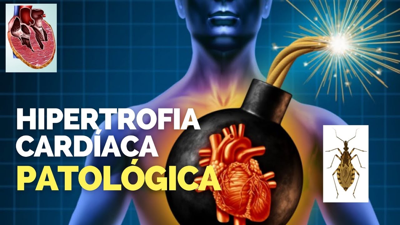 HIPERTROFIA CARDÍACA DO TIPO PATOLÓGICA - CARDIOMEGALIA