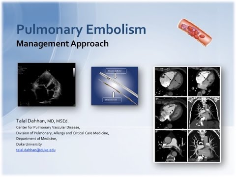 Pulmonary Embolism, An approach to Management -- BAVLS
