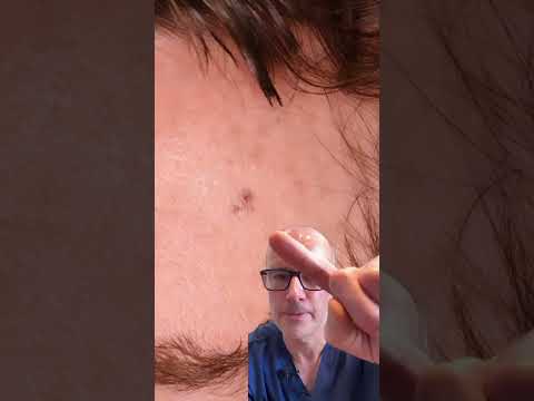 Early Stage Melanoma: A Life-Saving Detection