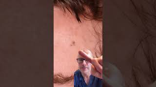 Download lagu Early Stage Melanoma: A Life-Saving Detection mp3 Download lagu Early Stage Melanoma: A Life-Saving Detection mp3