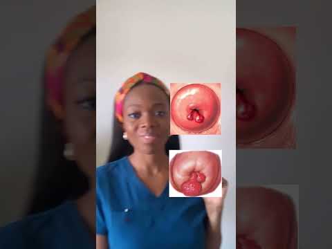 What are cervical polyps? Learn more here. #cervicalpolyps #polyps #healthawareness