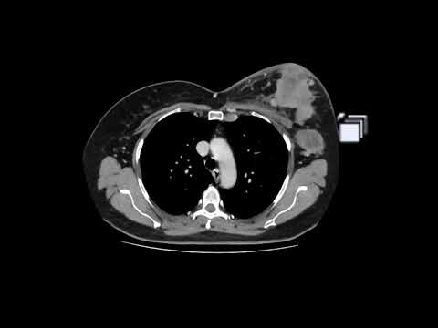 Conglomerado axilar em caso de carcinoma inflamatório da mama. Achados tomográficos.