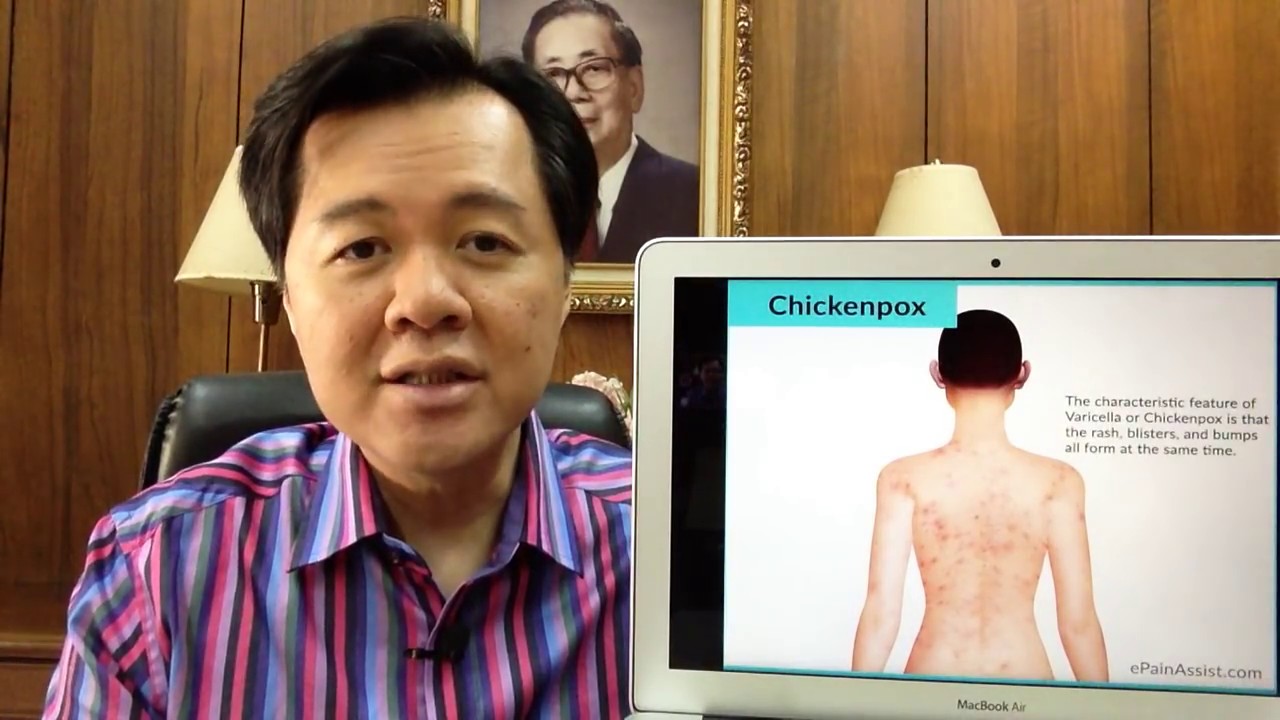 Chicken Pox o Bulutong Tubig - Payo ni Dr Willie Ong #100