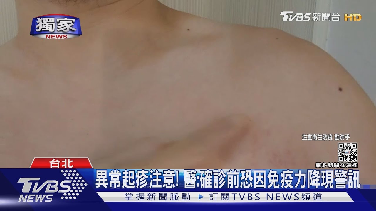 長新冠症狀+1 女解隔後遇「皰疹、蕁麻疹」纏身