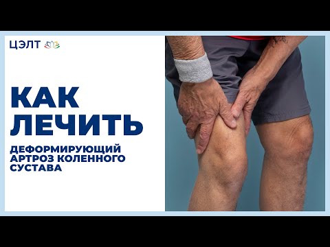 🚶 Как лечить деформирующий артроз коленного сустава. Деформирующий артроз коленного сустава. 12+