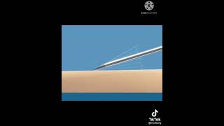 Download lagu PROSEDUR PEMASANGAN INFUS YANG BENAR mp3