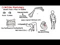 Osteogenesis Imperfecta