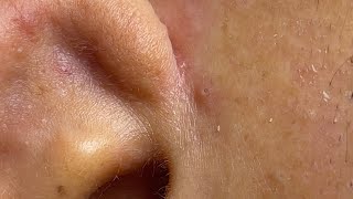 Relaxing Acne Removal with Linh Mydang #577 P3