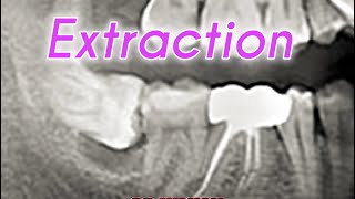 Horizontal Wisdom Tooth Extraction 