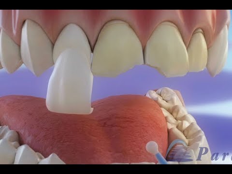 दंत लिबास – Veneers ©